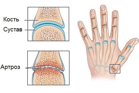 Остеоартроз кистей рук: симптомы, диагностика и методы лечения