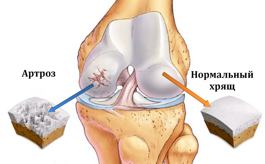 Артроз (гонартроз, остеоартроз) коленного сустава: симптомы и лечение