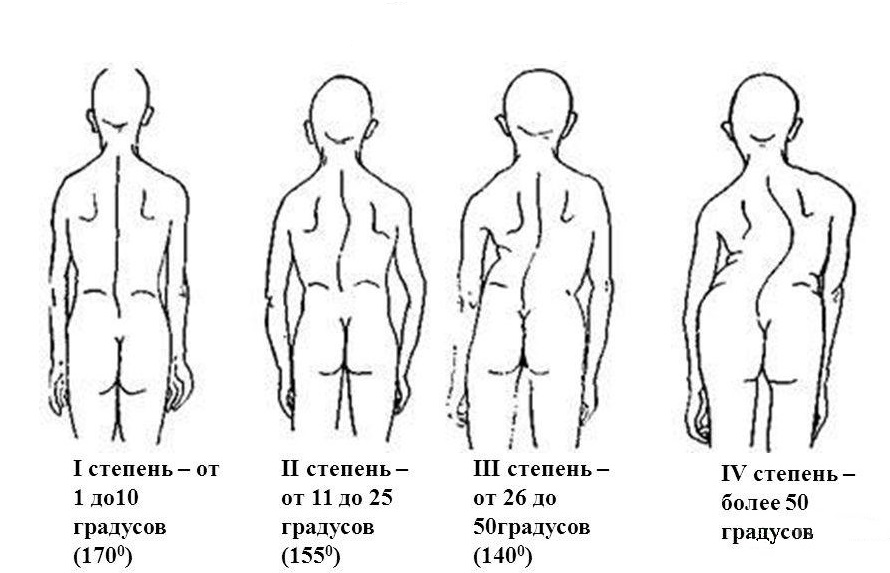 Левосторонний и правосторонний сколиоз грудного и поясничного отдела