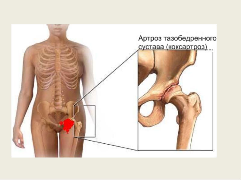 Диспластический коксартроз тазобедренного сустава - причины развития, симптомы и лечение