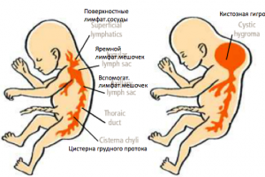 Гигрома шеи у плода. Гигрома подколенной ямки у ребенка: причины и лечение