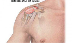 Бурсит плечевого сустава: причины развития заболевания, диагностика и лечение