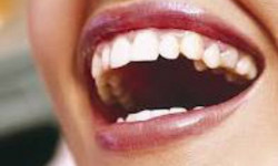 Биологически активное стекло продлит жизнь зубов