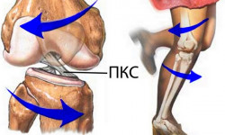 Повреждение передней крестообразной связки коленного сустава