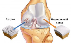 Артроз коленного сустава (гонартроз): диагностика и лечебные мероприятия