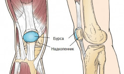 Симптомы и лечение бурсита коленного сустава