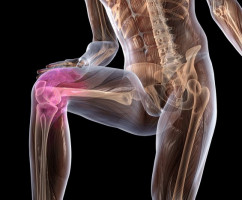 Что делать, если вылетает колено (нестабильность коленного сустава)?