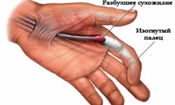 Причины и лечение стенозирующего лигаментита (синдром щелкающего пальца)