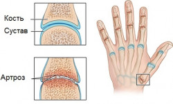 Определение и лечение артроза мелких суставов кистей рук
