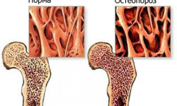 Диффузный остеопороз. Особенности заболевания, причины, лечение