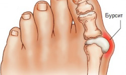 Как избавиться от бурсита большого пальца стопы (ноги)?