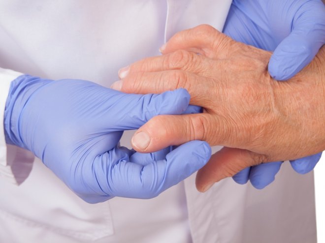 Ревматоидный артрит: причины, симптомы и лечение