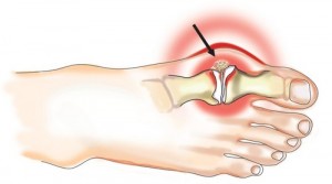 Диета при артрите суставов пальцев ног thumbnail