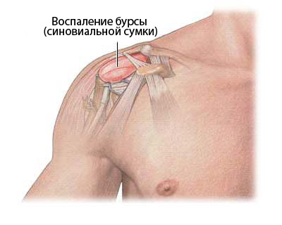 Субкоракоидальный бурсит плечевого сустава лечение