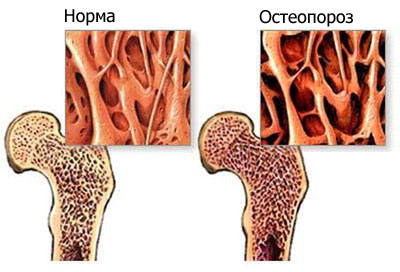Диффузный остеопороз костей