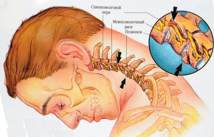 Остеохондроз шеи и поясницы лечение thumbnail