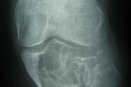 Опухоль колена рентген