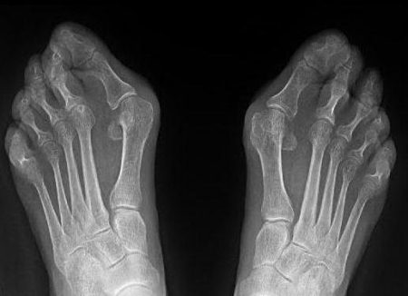 рентген суставов ног