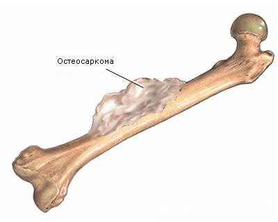 Экзостоз трубчатой кости
