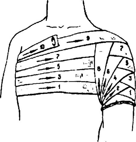 повязка на плечевой сустав