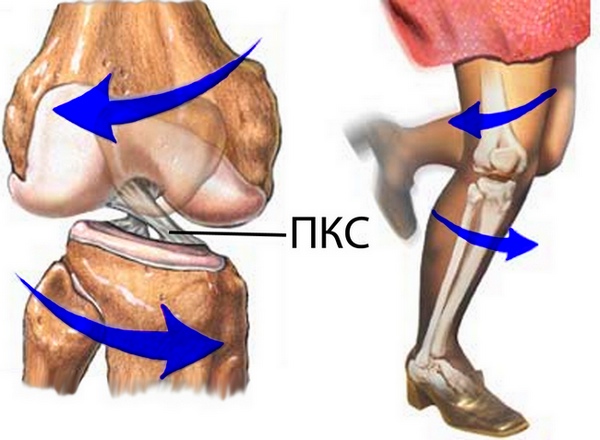 Повреждение передней крестообразной связки коленного сустава: признаки, как лечить