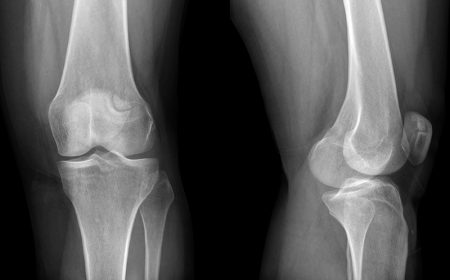 Рентген колена