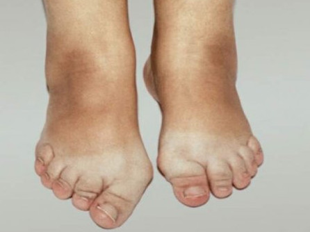 Изображение - Воспаление суставов рук и ног 331