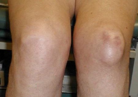 Опухоль коленного сустава