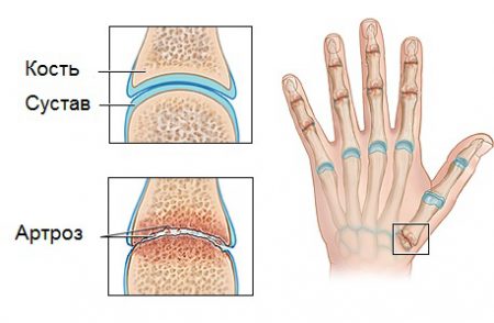 Изображение - Воспаление суставов рук и ног artroz-kistej-palcev-ruk_0-450x294