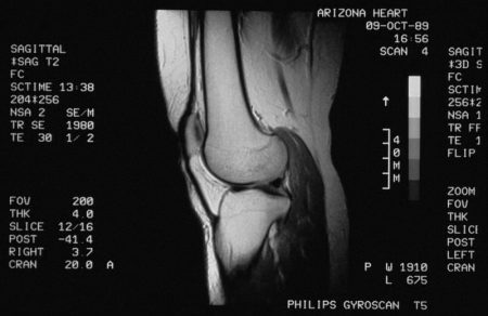 МРТ снимок колена