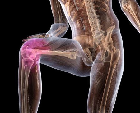 Остеоартроз колена