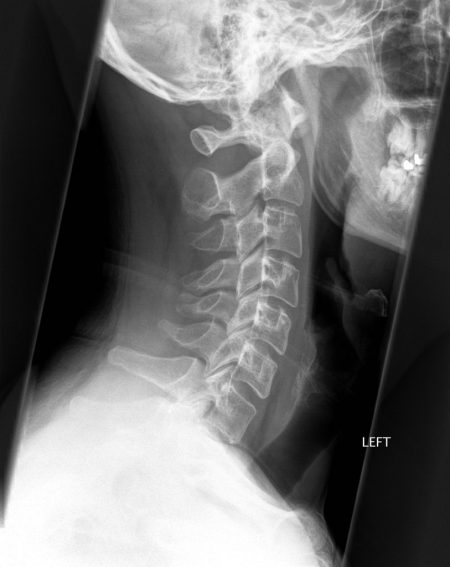 Рентген шейного отдела