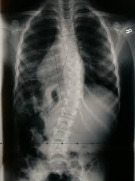 Рентген грудного отдела