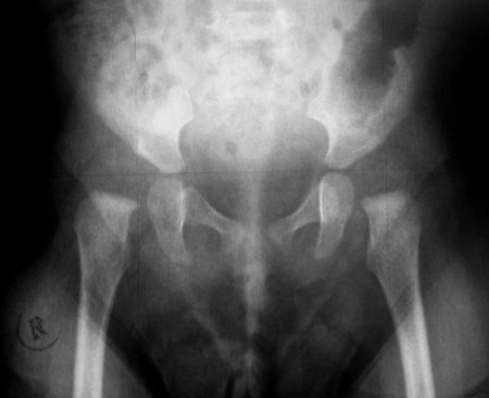Рентген тазобедренных суставов у детей