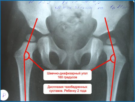 Изображение - Дисплазии тазобедренного сустава рентгенограммы dysplasia_hip_joints3-450x339